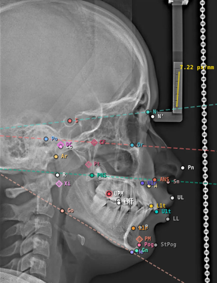 Radiografía lateral de cráneo con 29 puntos cefalométricos marcados y los planos FH, SN, MP y PP trazados.